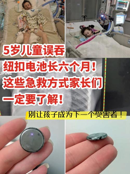 2岁娃误吞纽扣电池，两岁孩子误食纽扣电池