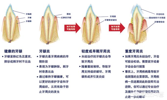 牙周炎一次拔14颗牙，牙周炎一次拔14颗牙可以吗