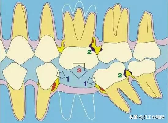 牙周炎一次拔14颗牙，牙周炎一次拔14颗牙可以吗