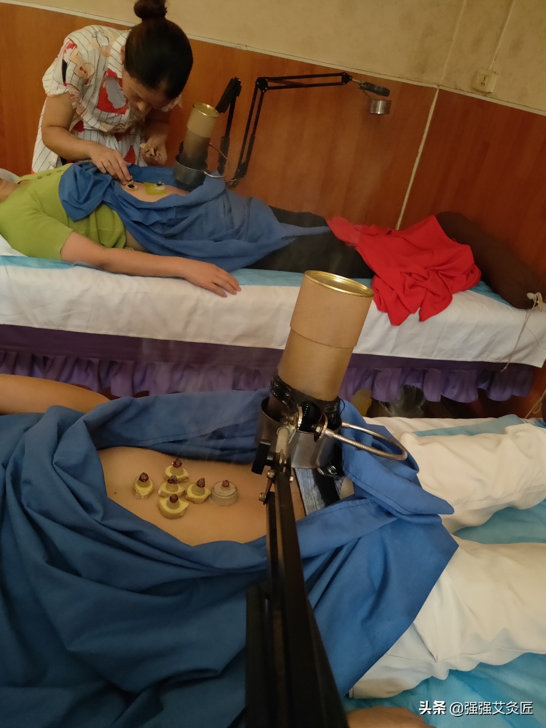 做艾灸致2度烫伤，艾灸严重烫伤