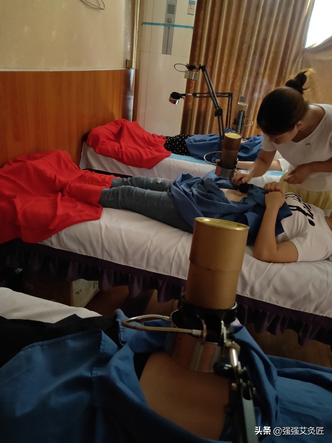 做艾灸致2度烫伤，艾灸严重烫伤