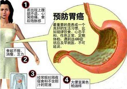 这种胃癌偏爱年轻人，胃癌年轻人知乎