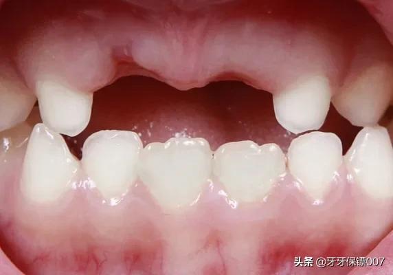 4岁娃全麻拔乳牙身亡，4岁娃全麻拔乳牙身亡率高吗