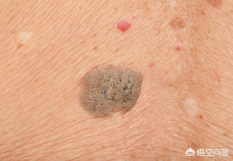 8成女性感染过HPV，8成女性感染过HPV