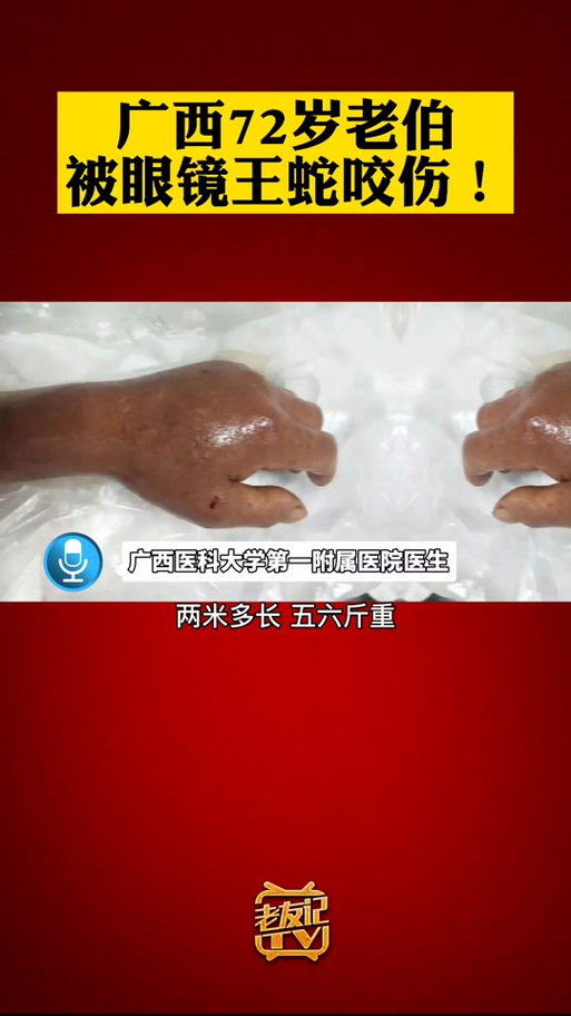 救助眼镜蛇反被咬伤，眼镜蛇被咬了有救吗