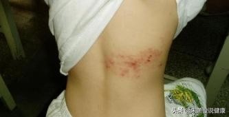 曝知名歌手患蛇缠腰，