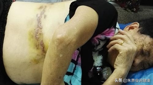 曝知名歌手患蛇缠腰，