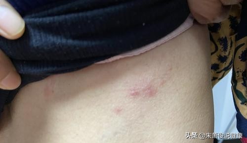曝知名歌手患蛇缠腰，
