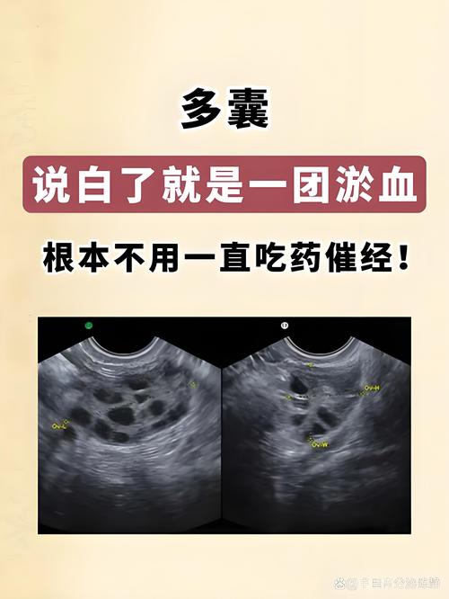 胖多囊vs瘦多囊，胖多囊vs瘦多囊哪个好