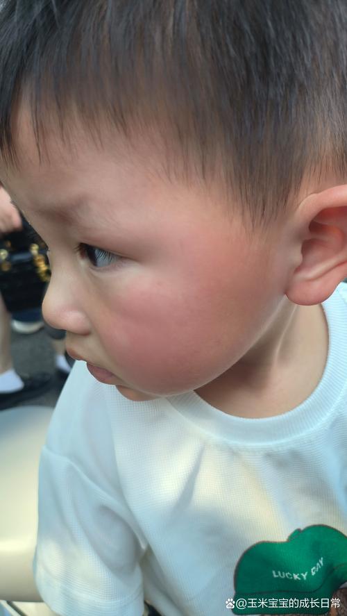 亲10月龄娃脚后嘴肿，小孩脚肿嘴肿是什么情况