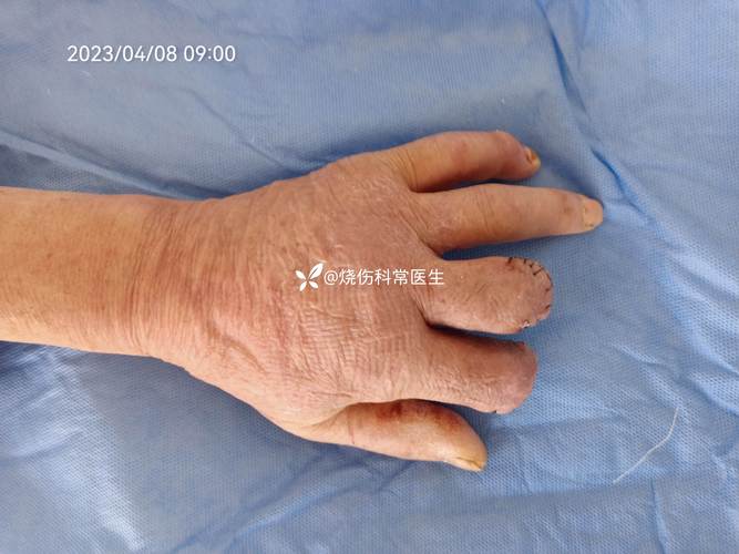 冻伤要到烧伤科就诊，冻伤要到烧伤科就诊怎么办