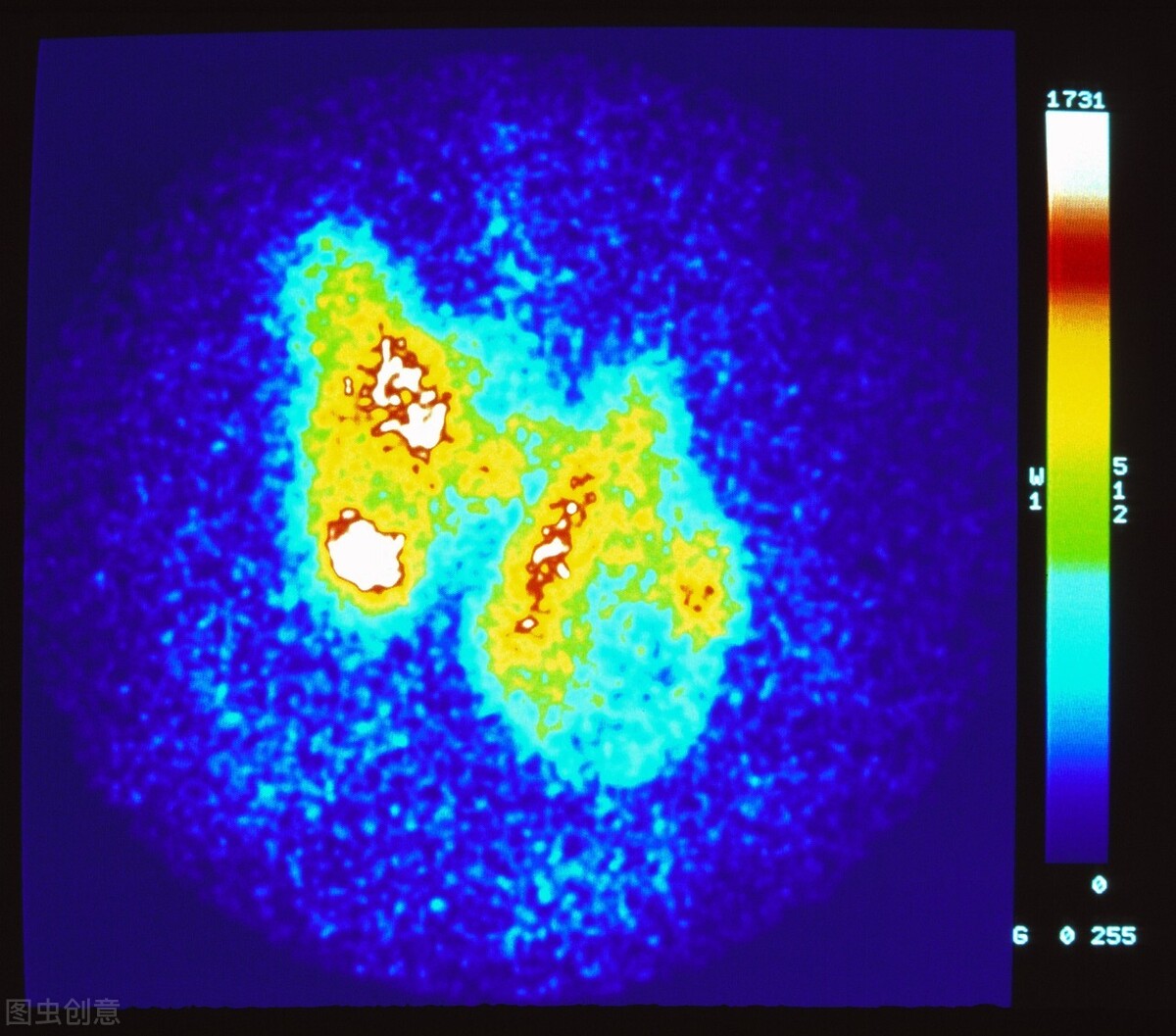 甲状腺癌越来越常见，甲状腺癌越来越常见,年轻人易中招