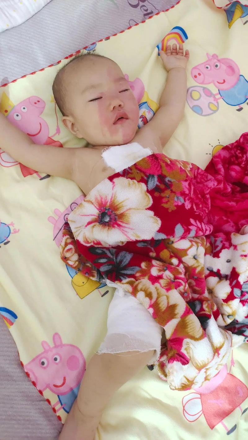 睡觉用暖宝宝被烫伤，睡觉用暖宝宝被烫伤了