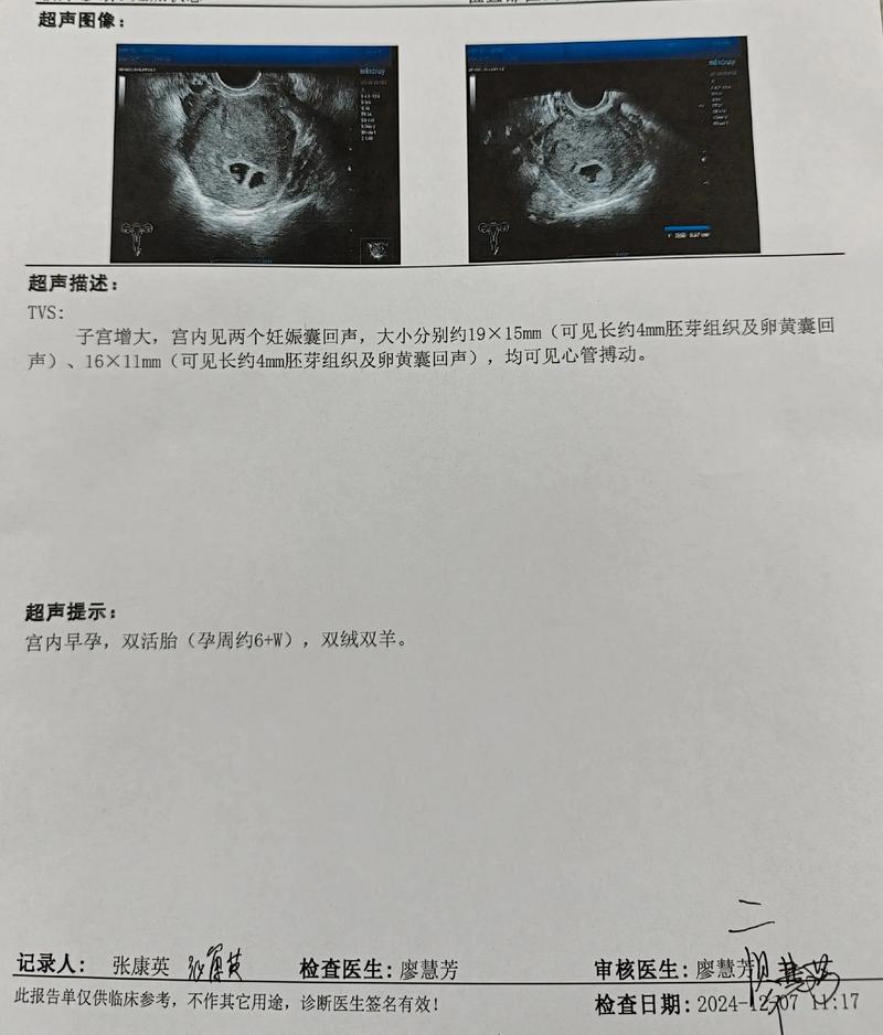 怀双胎流产后腹痛，怀双胎流产后腹痛查出第3子