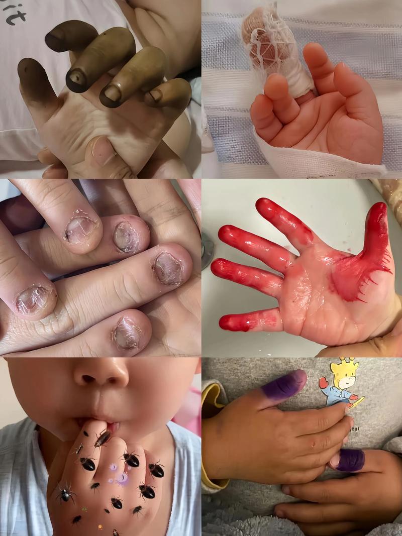 孩子手指被兔子咬掉，孩子手指被兔子咬掉了怎么办